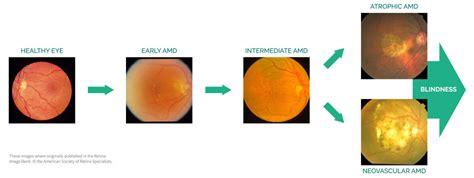 Age-related Macular Degeneration - Eyenuk, Inc. ~ Artificial ...