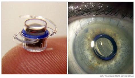 Eye telescope implant gains FDA approval | TechAutos