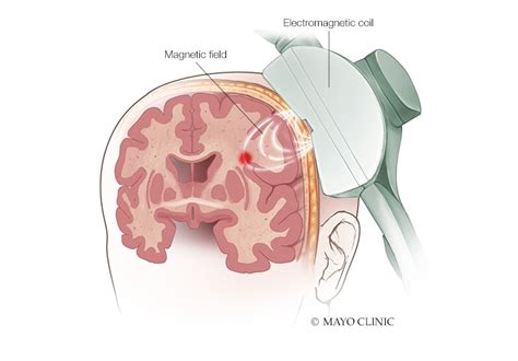 Multiple options for the treatment of children with epilepsy - Mayo Clinic