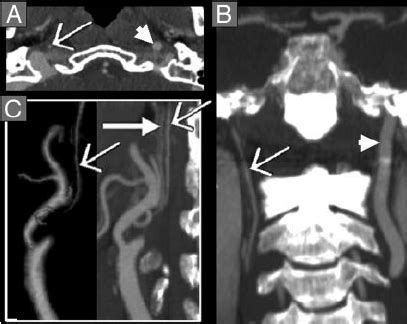 Near-occlusion ICA stenosis with distal ICA collapse, threadlike ...