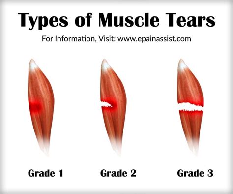 Muscle Tear|Types|Treatment|Recovery Period|Causes|Symptoms