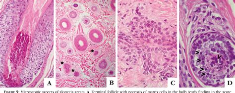 Figure 5 from Clinical and histological challenge in the differential diagnosis of diffuse ...