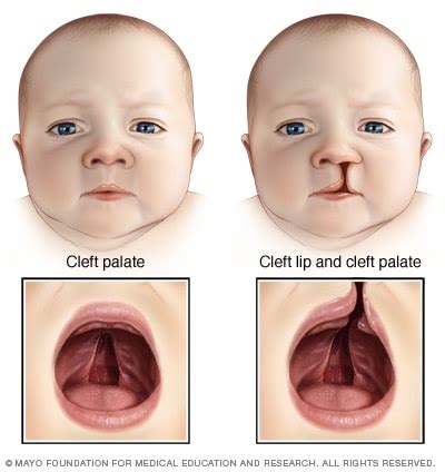 Cleft lip and cleft palate - Symptoms and causes - Mayo Clinic