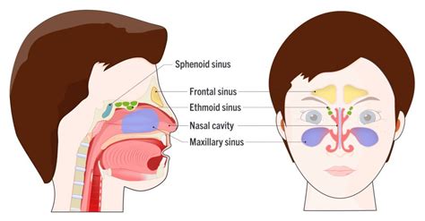 Repulsión Pesimista Contradecir blocked sinus cavity desempleo grua Injusto