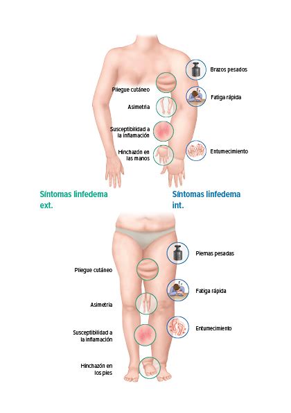 Linfedema - Juzo