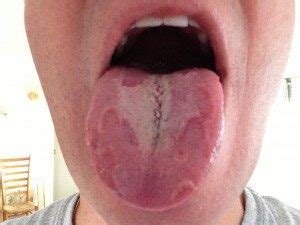 Geographic tongue can be treated with apple cider vinegar