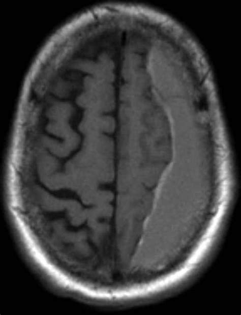 Subdural Hematoma Mri