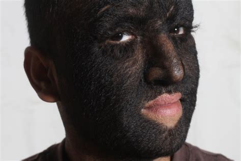 Hypertrichosis. What is it? How do you avoid it? Learn Here!