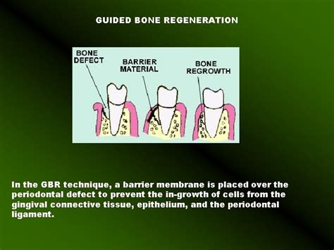 Guided Tissue regeneration and Guided Bone Regeneration Guided