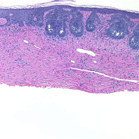 Dermatofibroma (Fibrous histiocytoma) - The Clinical Advisor