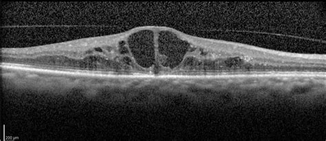 OCT image showing cystoid macular edema - Endotext