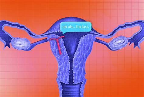 What to Look for When You Think Your IUD Has Fallen Out