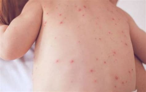 10 Signs and Symptoms of Measles You Need to Know