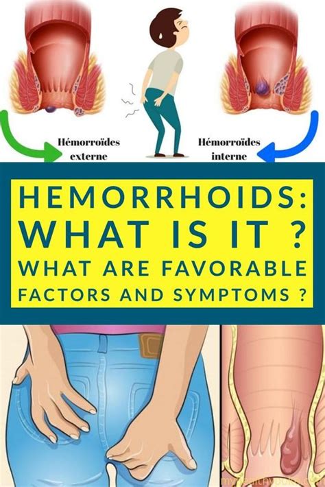 Hemorrhoids: What is it ? What are favorable factors and symptoms ? - Page 11 of 11 in 2020 ...