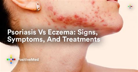 Psoriasis Vs Eczema: Signs, Symptoms, And Treatments - PositiveMed