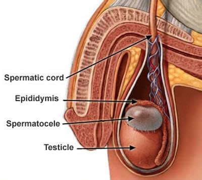 Epididymal Cyst