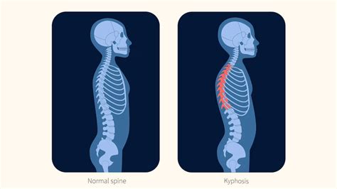 Understanding Dowager’s Hump: Causes, Symptoms, And Risk Factors ...