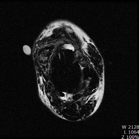 Extrasynovial Synovial Osteochondromatosis of the Ankle: A case report ...