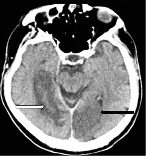 Figure 1 from Anton's Syndrome due to Bilateral Ischemic Occipital Lobe ...