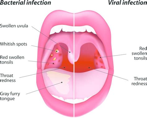 Sore Throat: Symptoms, Causes, Treatment, and Diagnosis | FindATopDoc