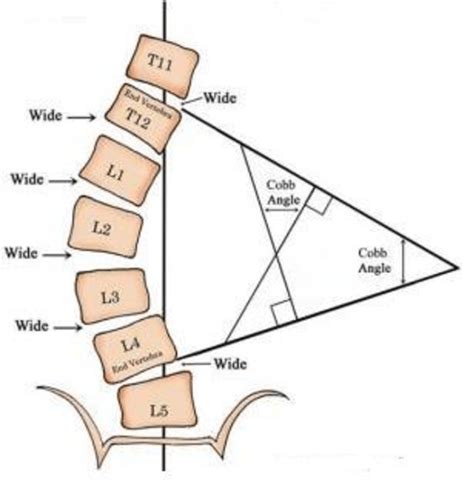 Manual method for measuring the Cobb-angle (available from:... | Download Scientific Diagram