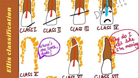 Tooth Fracture Classification