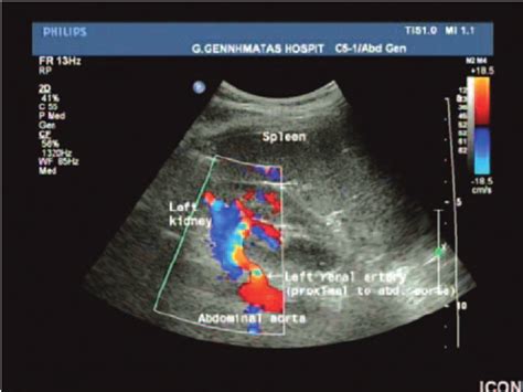 Kidney Doppler Ultrasound