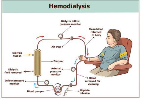 Hemodialysis Diagram