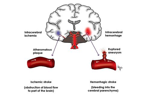 Cerebrovascular Accident: A Stroke of Misfortune