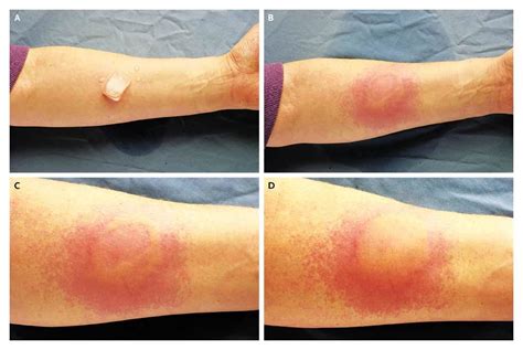 Cold-Induced Urticaria | NEJM