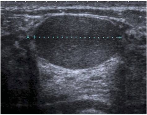 Variation in management of breast lesions with ultrasound appearances ...