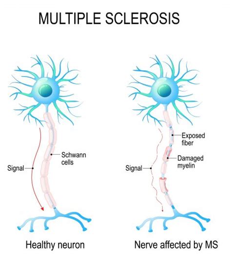 Multiple Sclerosis|Wellness Guru Australia