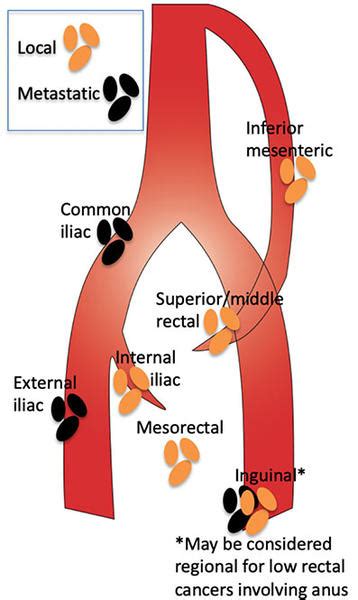 MRI Rectal Cancer Staging - RAD-ASSIST