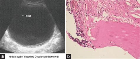 (a) Ultrasonography showing big mesenteric hydatid cyst, (b ...