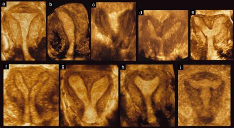 Three‐dimensional ultrasound in the diagnosis of Müllerian duct anomalies and concordance with ...