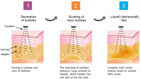 Ultrasonic Cavitation In Staten Island | Ultrasound Fat Cavitation NYC ...