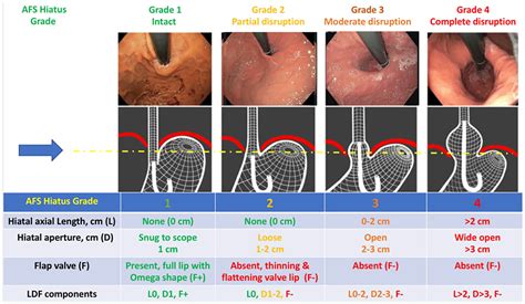 Grading of GERD: Hill vs. AFS classification