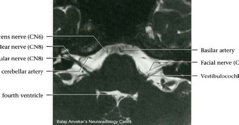 MRI Protocols: 7TH NERVE MRI Protocol(Facial Nerve)