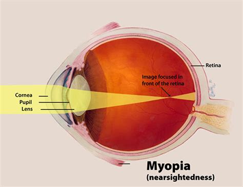 What is Astigmatism - Causes, Symptoms,Treatment