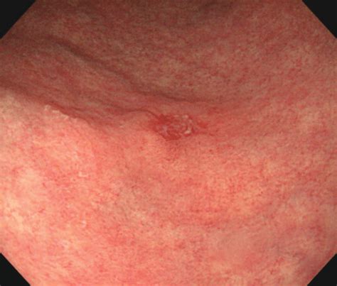 An elevated mucosal lesion with central depression is seen the greater... | Download Scientific ...