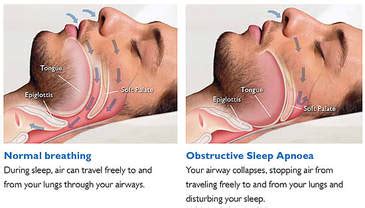 Sleep Apnea Treatment Malaysia