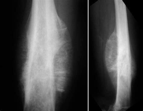 Osteogenic Sarcoma Sunburst