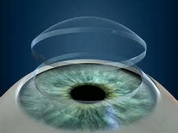 Corneal Transplant Surgery Terms Defined - Discovery Eye Foundation