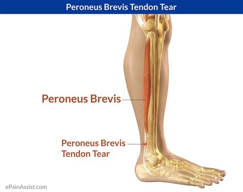 Peroneus Brevis Tendon Repair Pictures