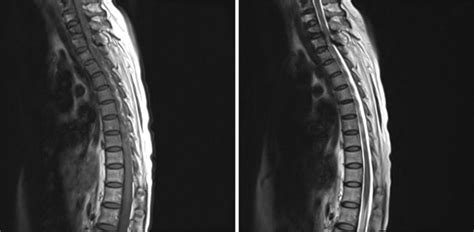 Sagittal view of the spinal MRI showing spinal cord compression by... | Download Scientific Diagram