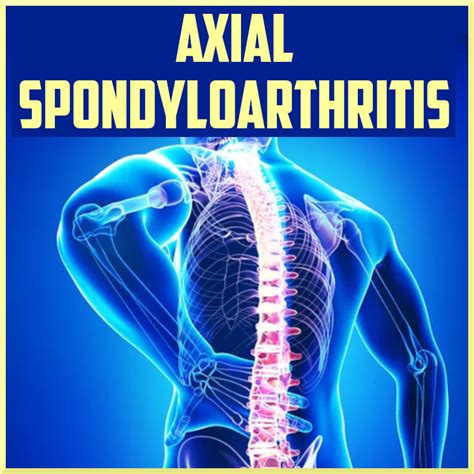 Axial Spondyloarthritis - Sports Medicine Review