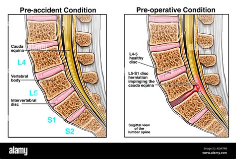 Hernie discale l5 s1 Banque de photographies et d’images à haute ...