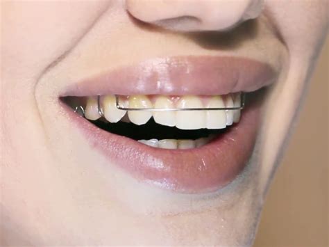 Removable Braces | Dr. Simon Toledano