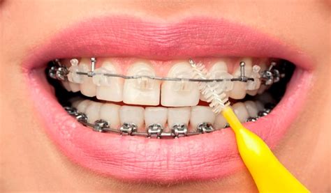 Orthodontics Australia | Caring For Braces: Top Tips On Caring And Wearing Braces