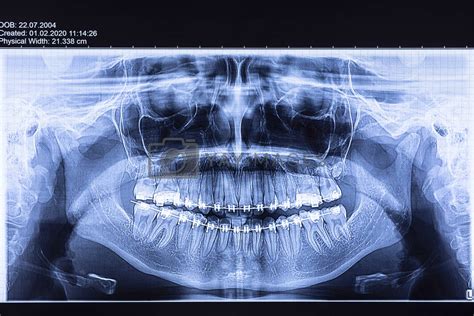 Dental radiography with braces by manaemedia Vectors & Illustrations ...